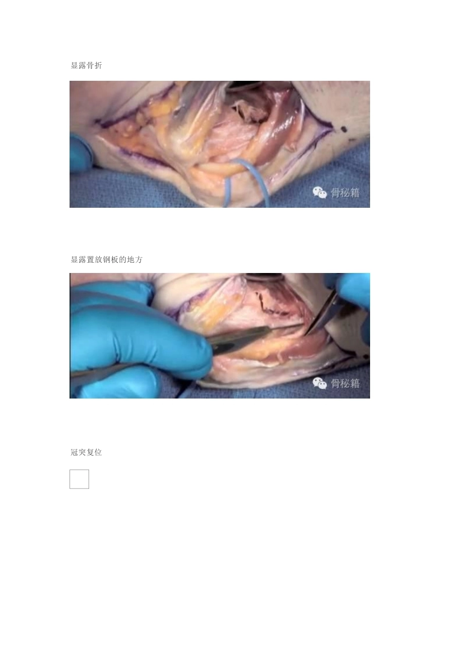 冠突骨折手 术技巧_第11页