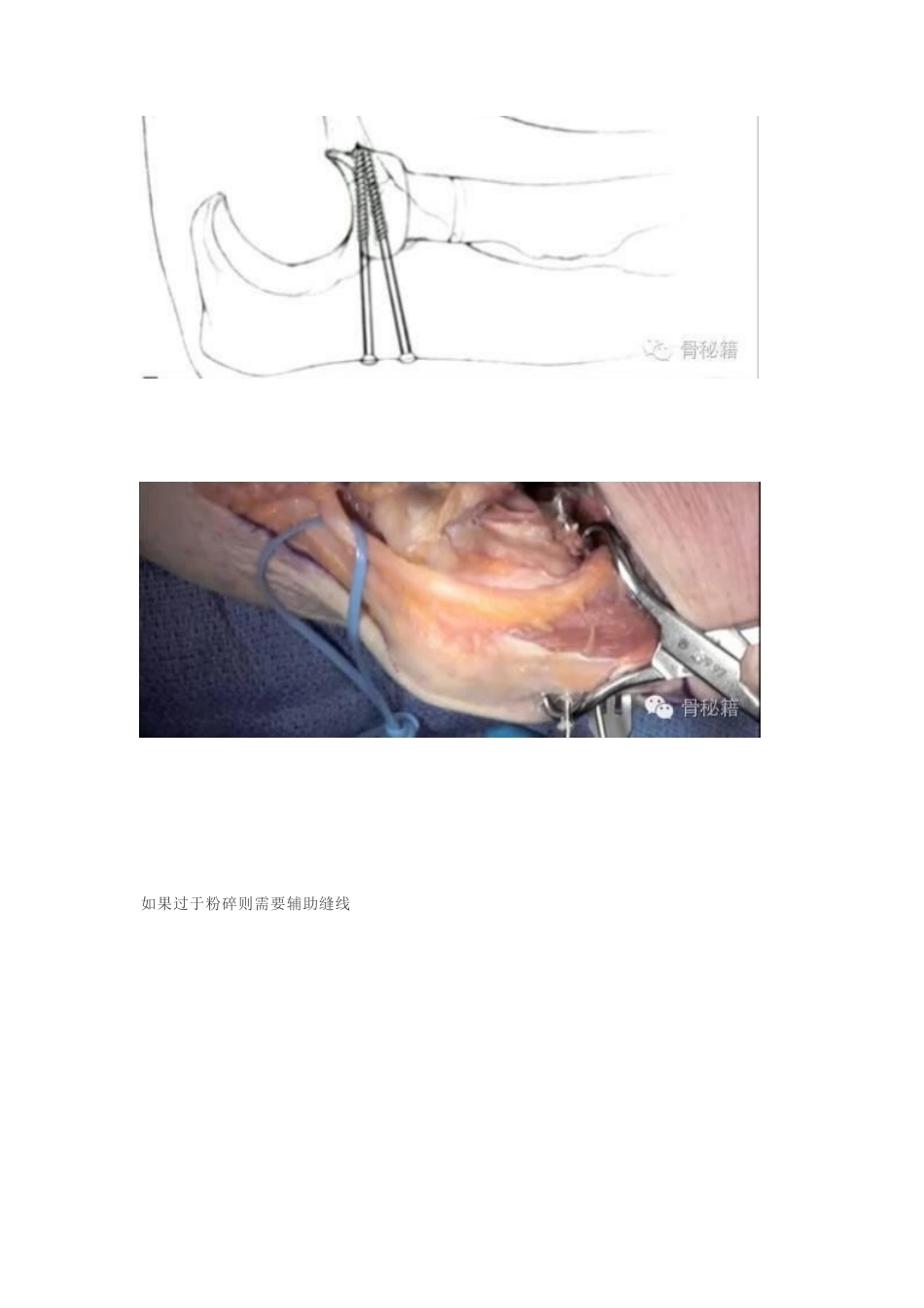 冠突骨折手 术技巧_第13页