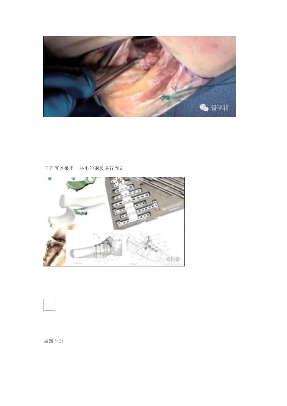 冠突骨折手 术技巧_第15页