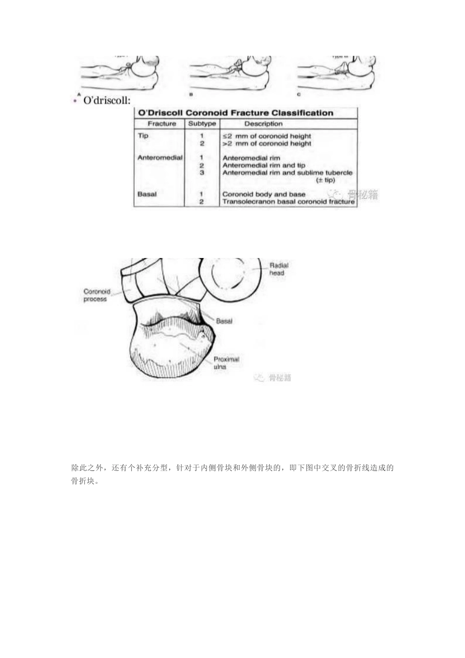 冠突骨折手 术技巧_第2页