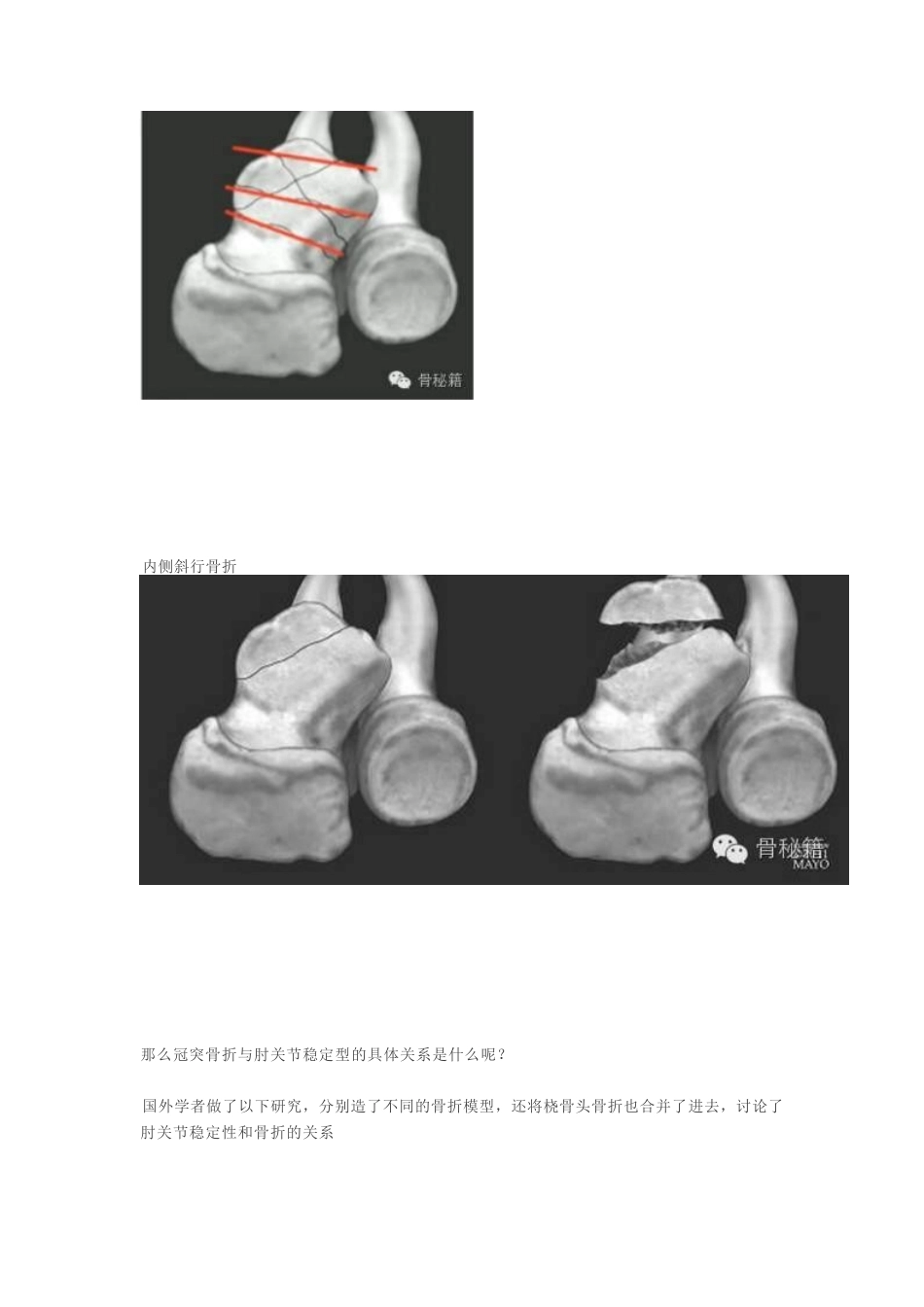 冠突骨折手 术技巧_第3页