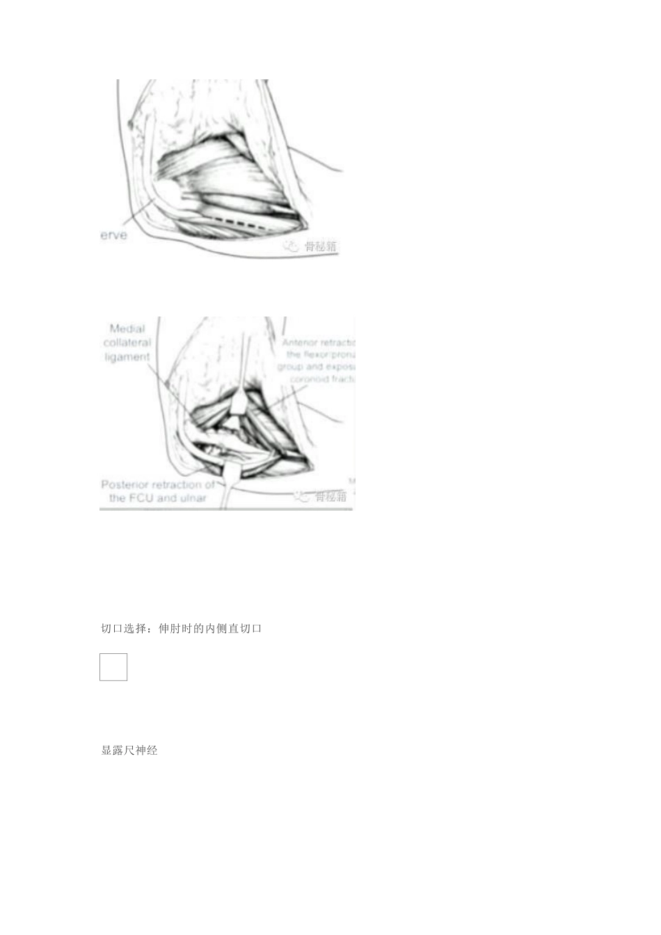 冠突骨折手 术技巧_第8页