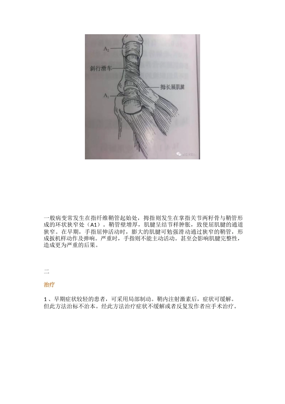 狭窄性腱鞘 炎治疗技巧_第2页