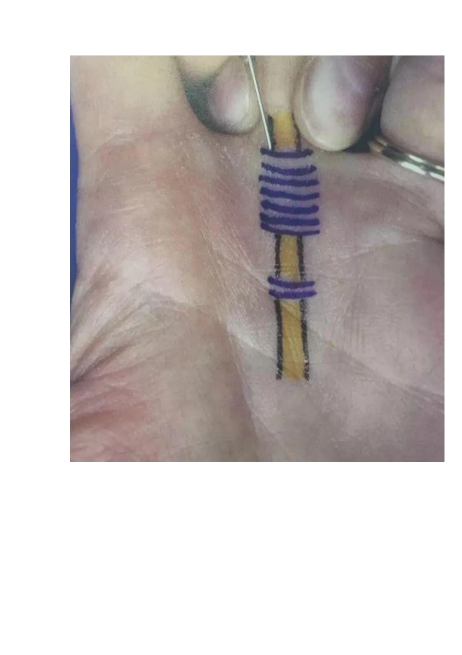 狭窄性腱鞘 炎治疗技巧_第3页