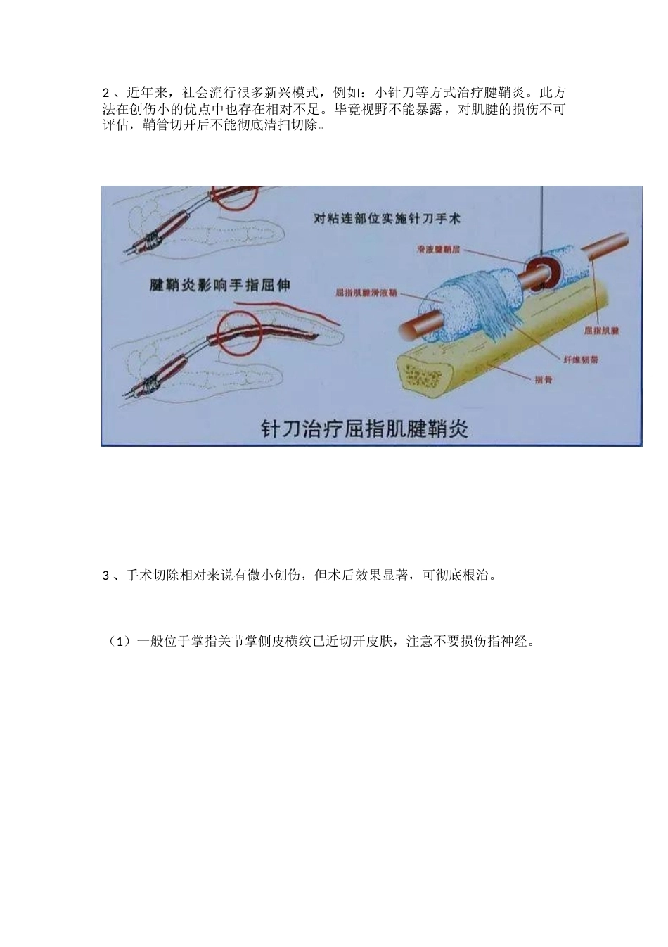 狭窄性腱鞘 炎治疗技巧_第4页