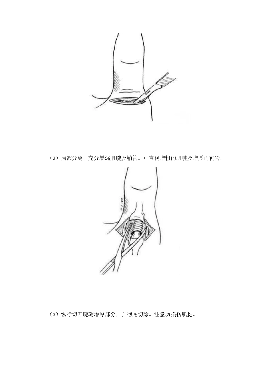 狭窄性腱鞘 炎治疗技巧_第5页