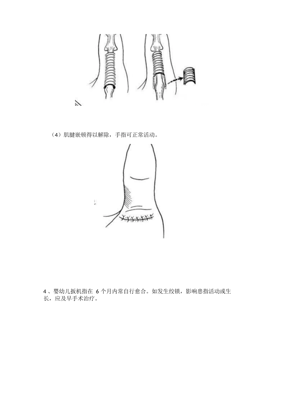 狭窄性腱鞘 炎治疗技巧_第6页