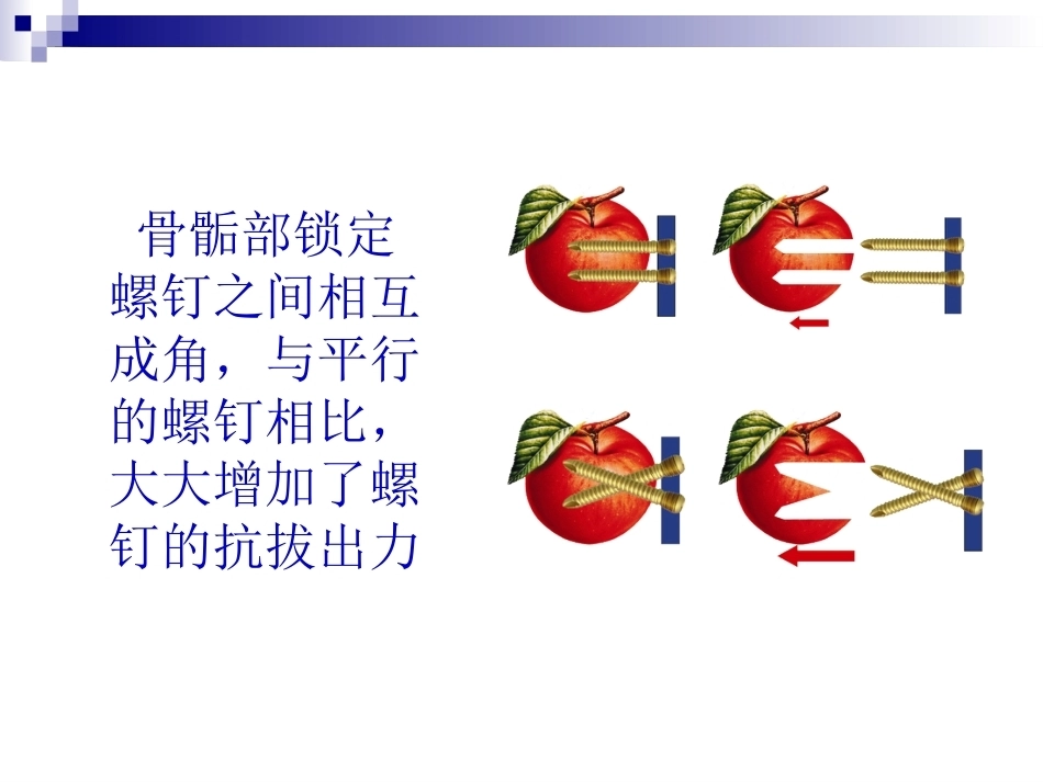 锁定钢板的应用及注意 事项_第11页