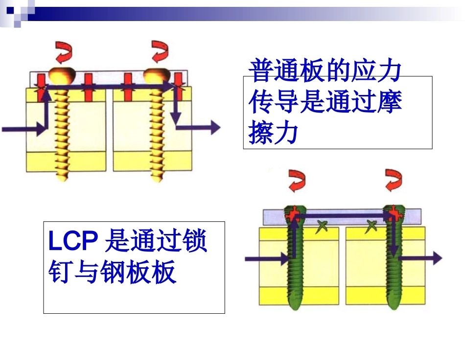 锁定钢板的应用及注意 事项_第8页