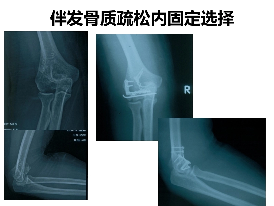 肱骨小头骨折的手术 技巧_第12页