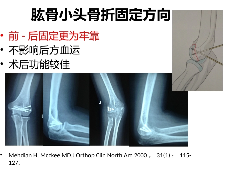 肱骨小头骨折的手术 技巧_第13页