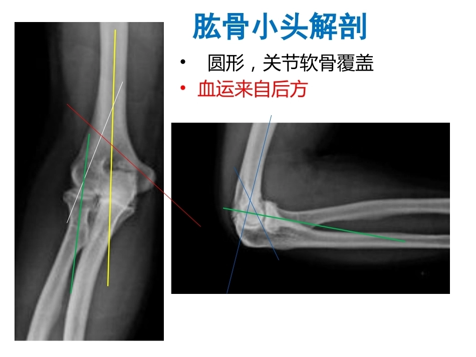 肱骨小头骨折的手术 技巧_第2页