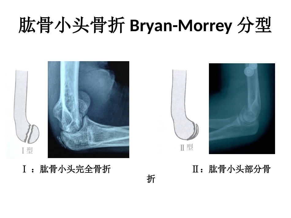 肱骨小头骨折的手术 技巧_第5页