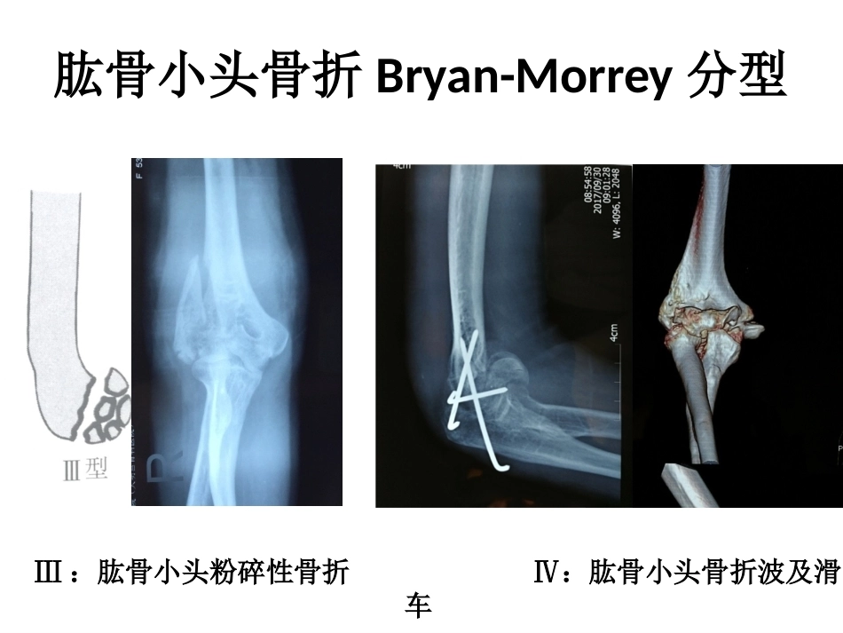 肱骨小头骨折的手术 技巧_第6页