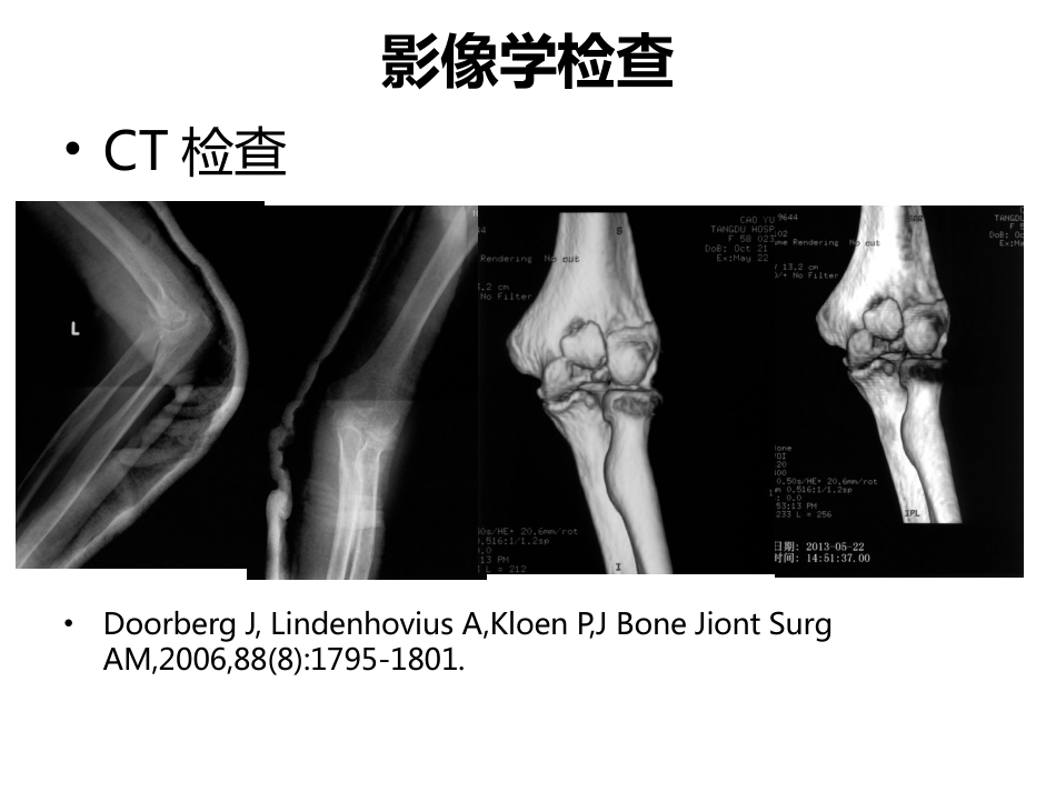 肱骨小头骨折的手术 技巧_第8页
