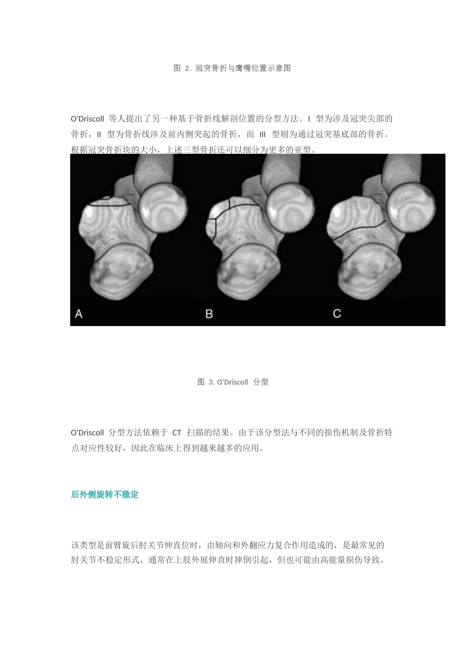 尺骨冠突骨折分型_第3页
