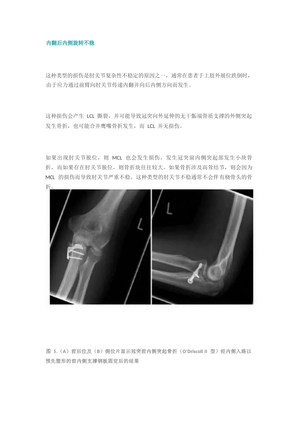 尺骨冠突骨折分型_第5页