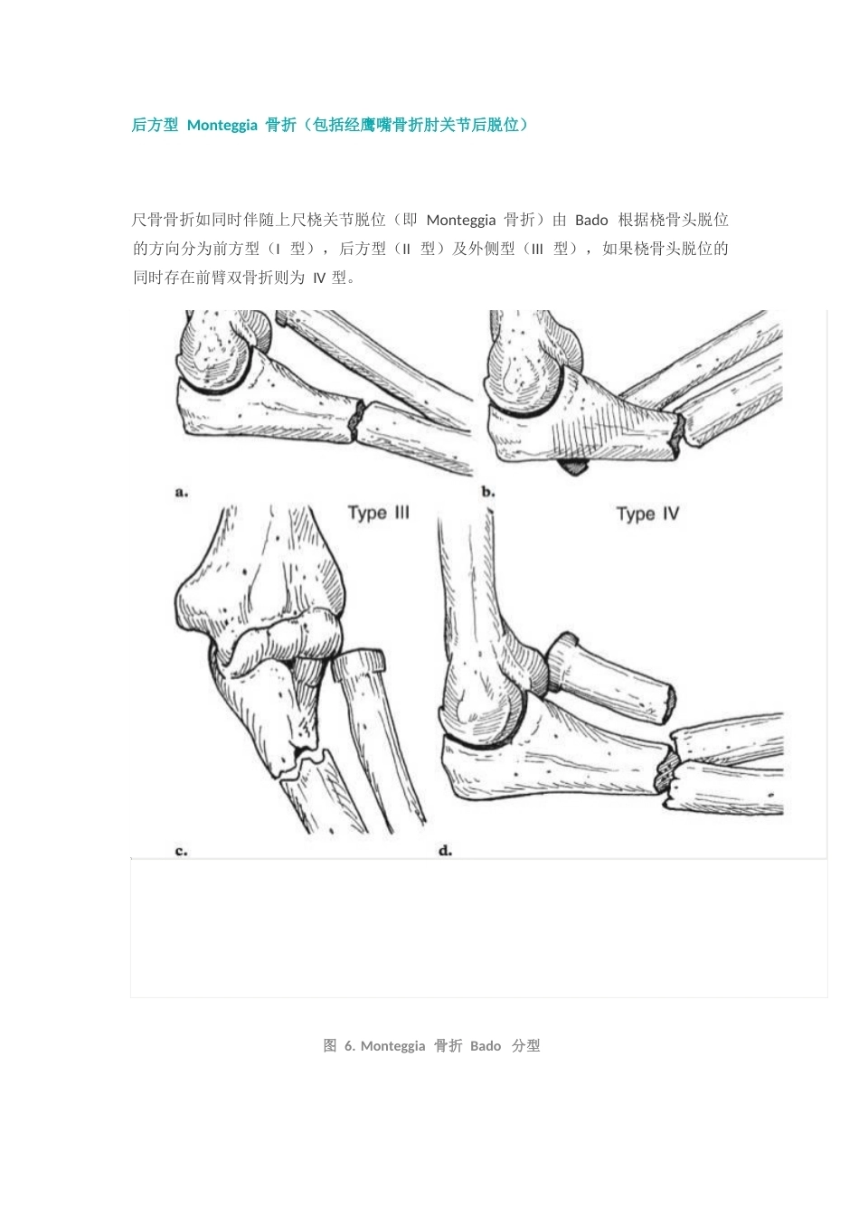 尺骨冠突骨折分型_第6页