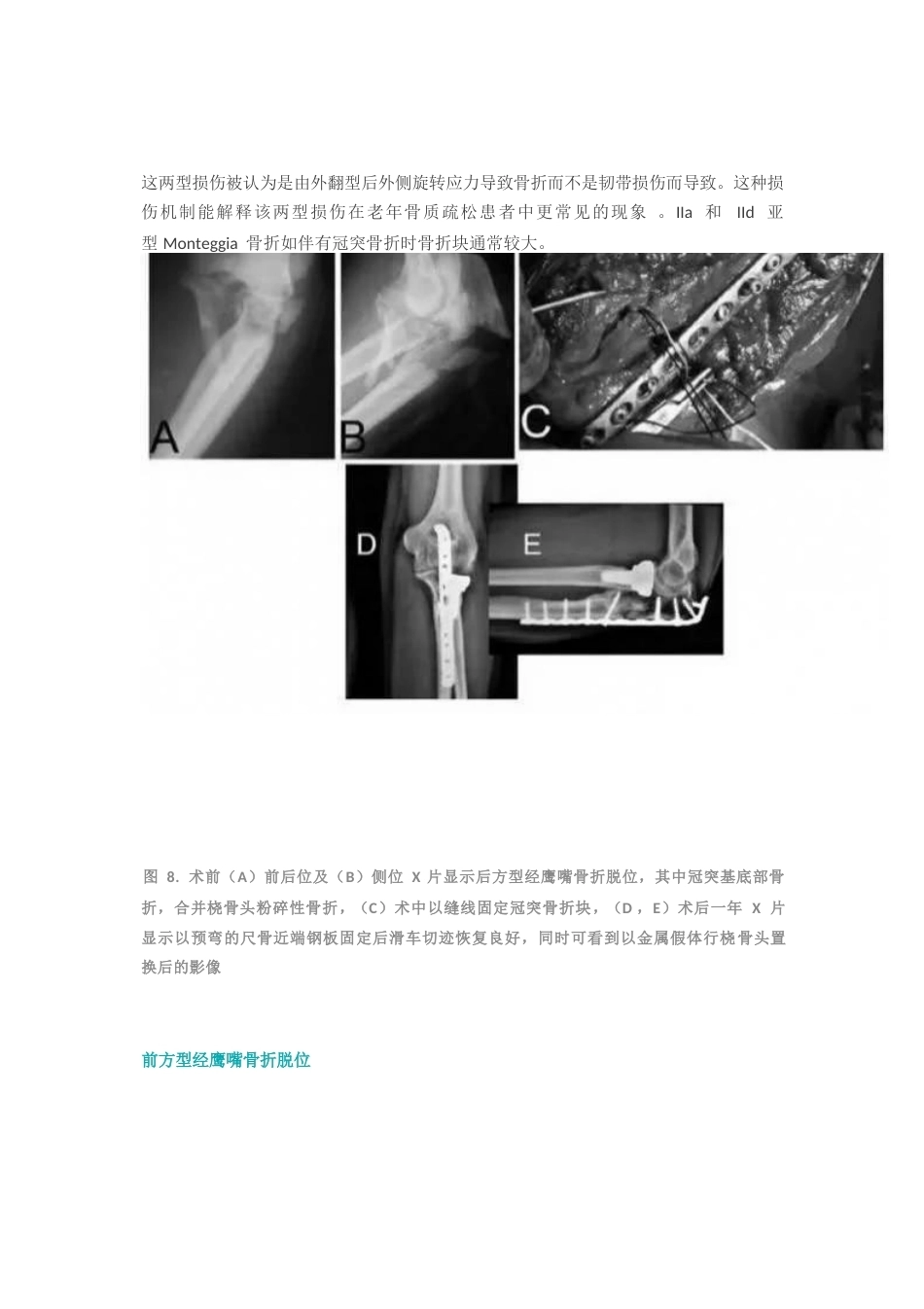 尺骨冠突骨折分型_第8页
