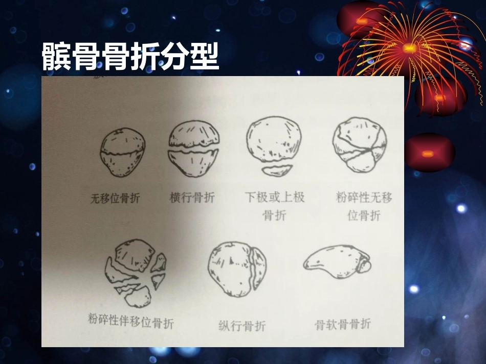 髌骨骨折的微创治疗_第2页