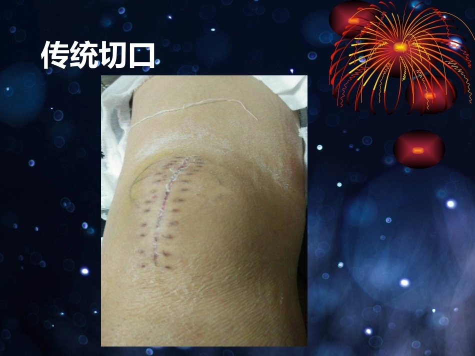 髌骨骨折的微创治疗_第6页