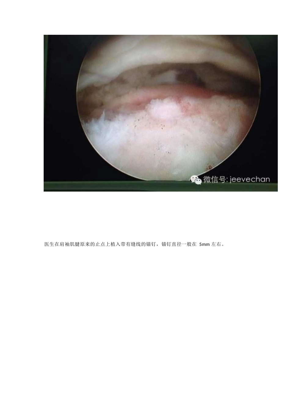 关节镜下肩袖修补的手 术技巧_第5页