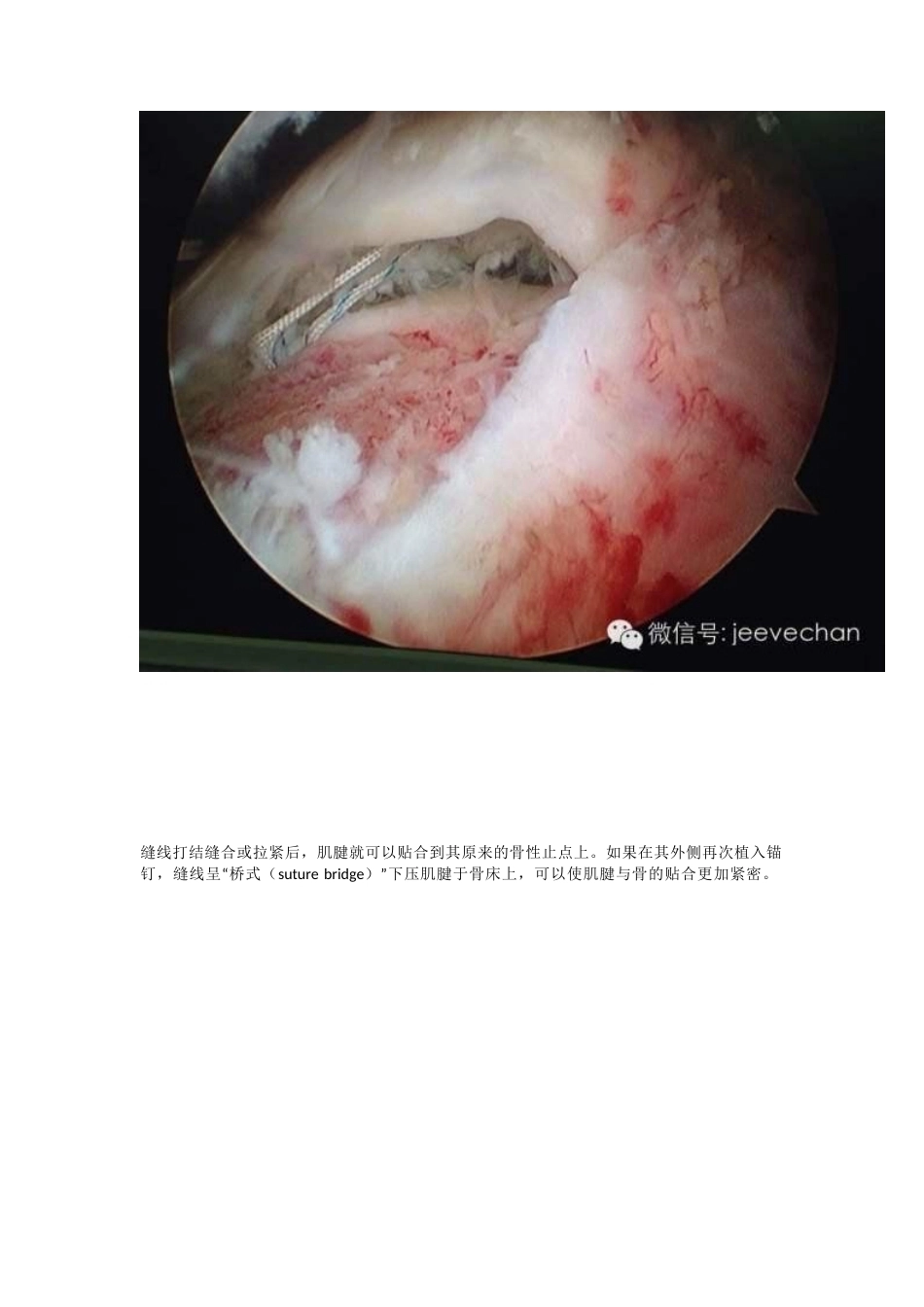 关节镜下肩袖修补的手 术技巧_第7页