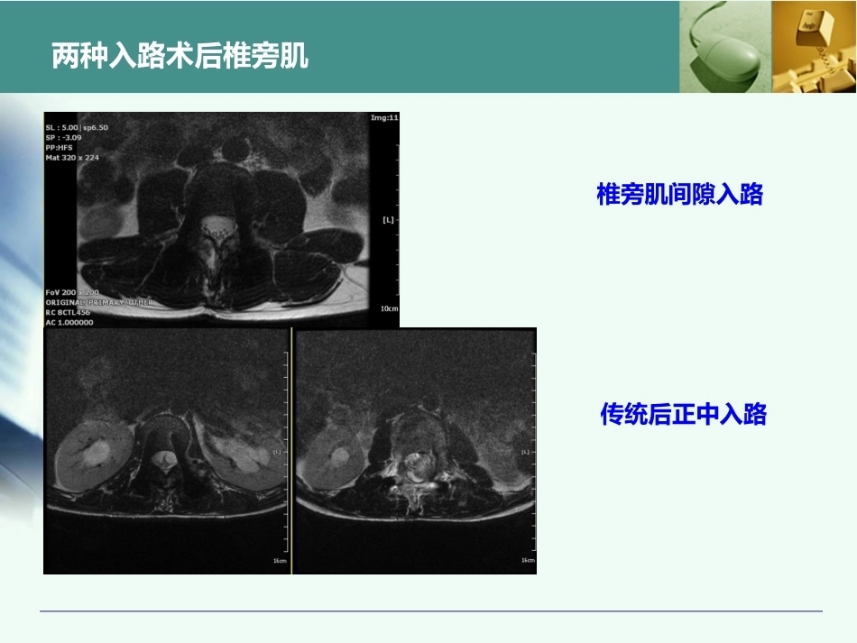 全胸腰椎椎弓根置钉技术_第10页