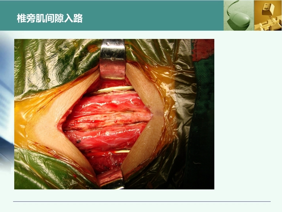 全胸腰椎椎弓根置钉技术_第8页