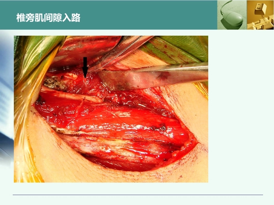 全胸腰椎椎弓根置钉技术_第9页