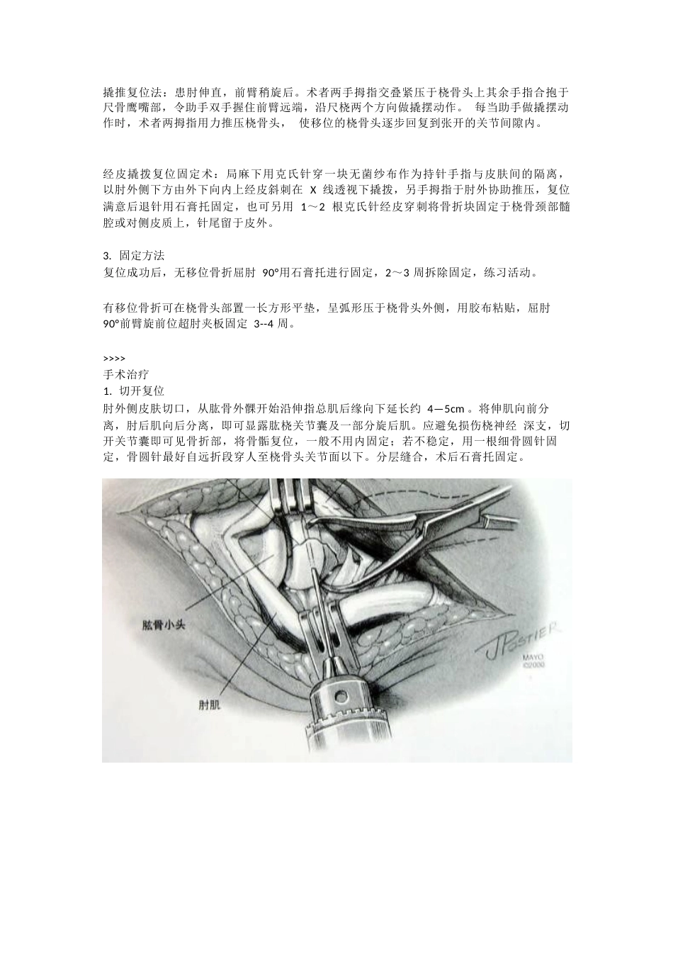 桡骨头骨折分型_第3页