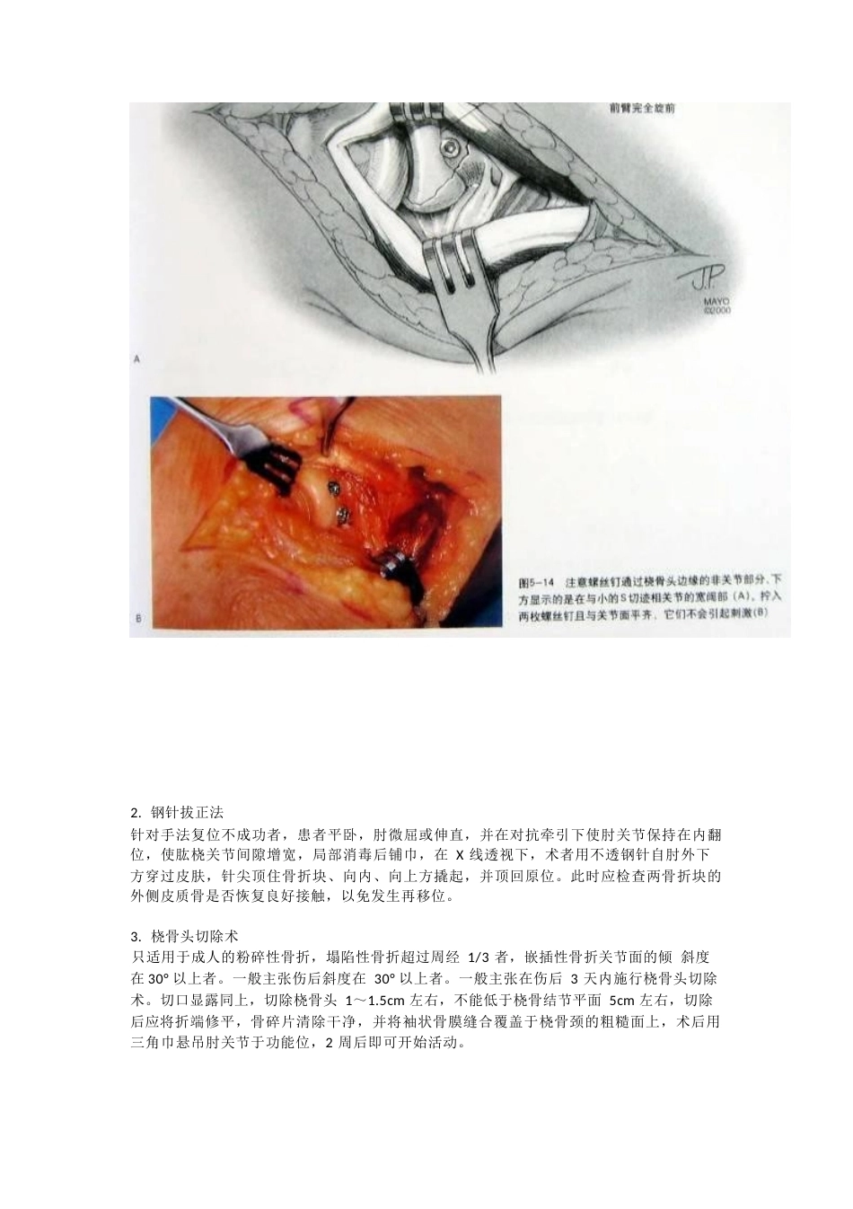 桡骨头骨折分型_第4页
