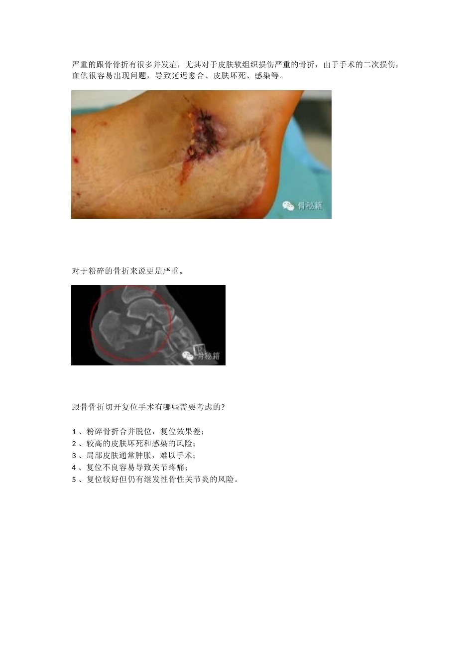 跟骨骨折 你还在切开吗_第1页