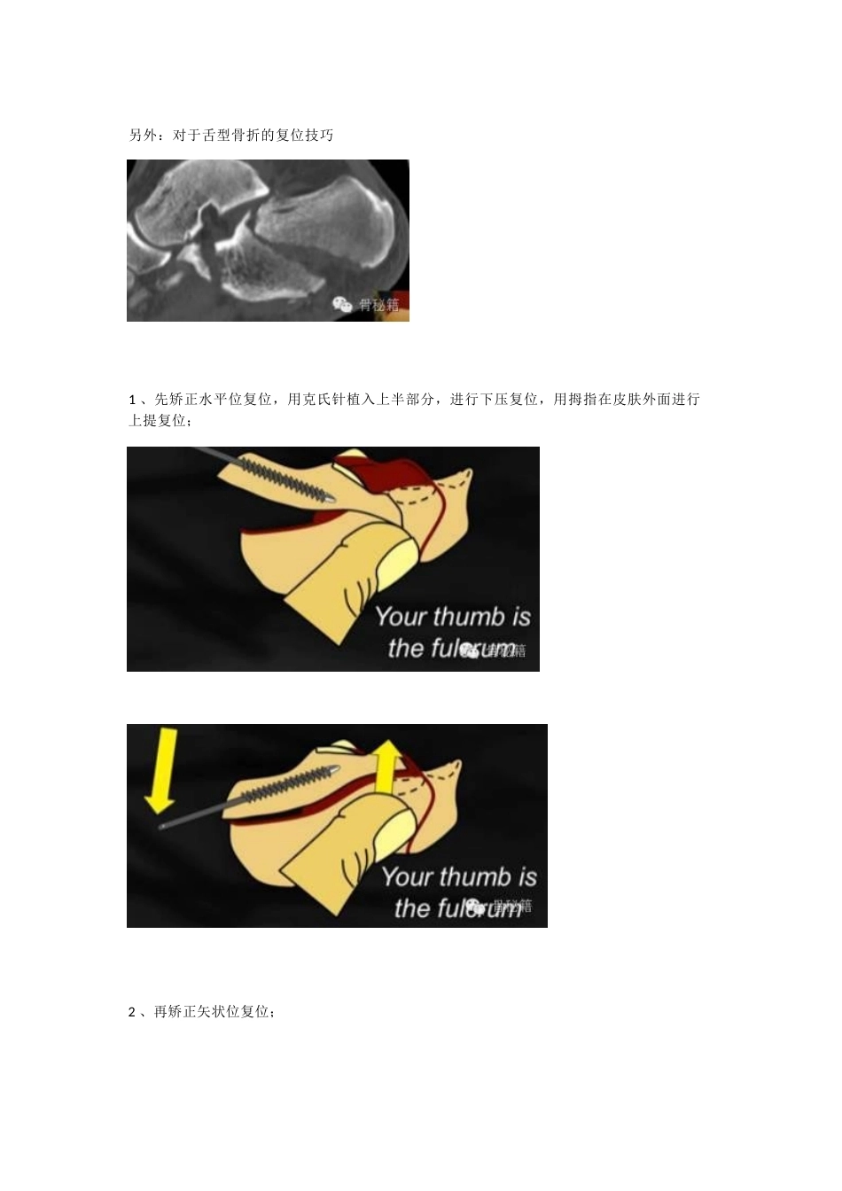 跟骨骨折 你还在切开吗_第10页
