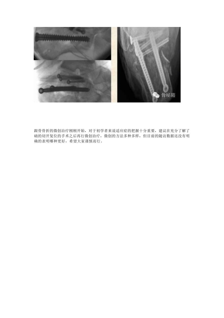 跟骨骨折 你还在切开吗_第13页