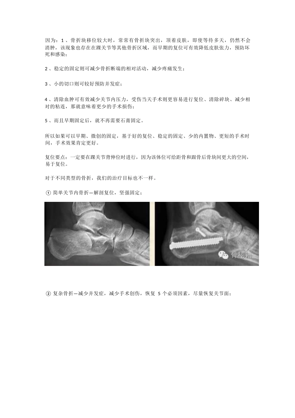 跟骨骨折 你还在切开吗_第3页