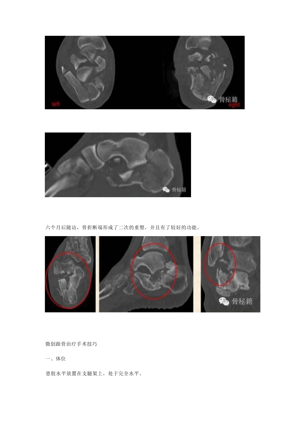跟骨骨折 你还在切开吗_第4页