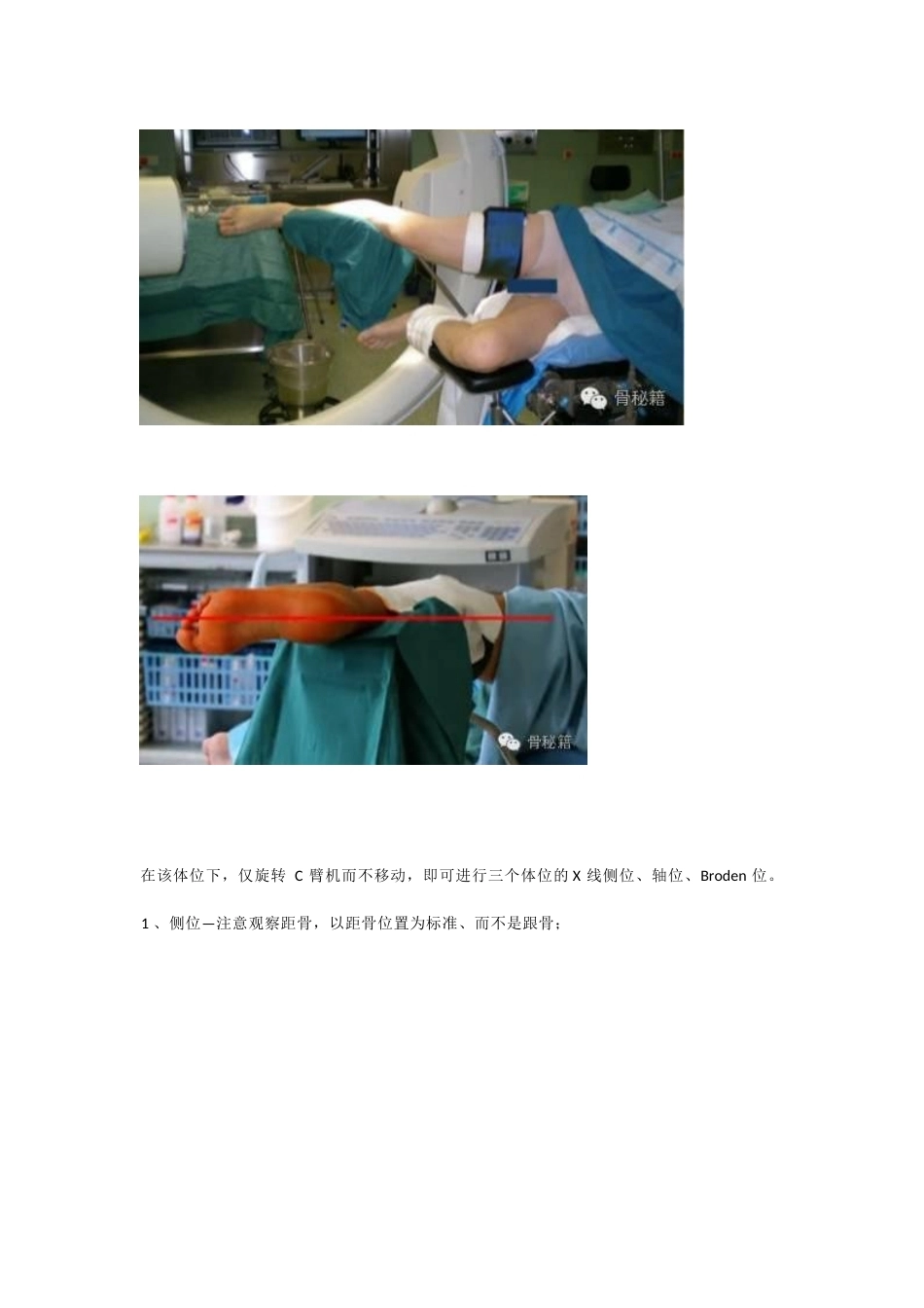 跟骨骨折 你还在切开吗_第5页