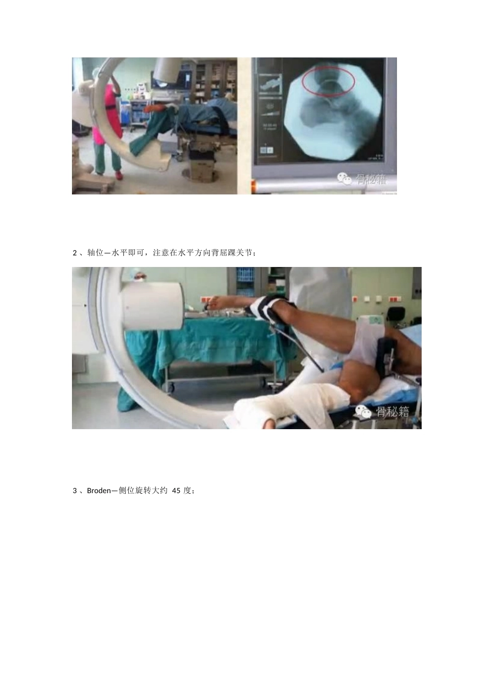 跟骨骨折 你还在切开吗_第6页