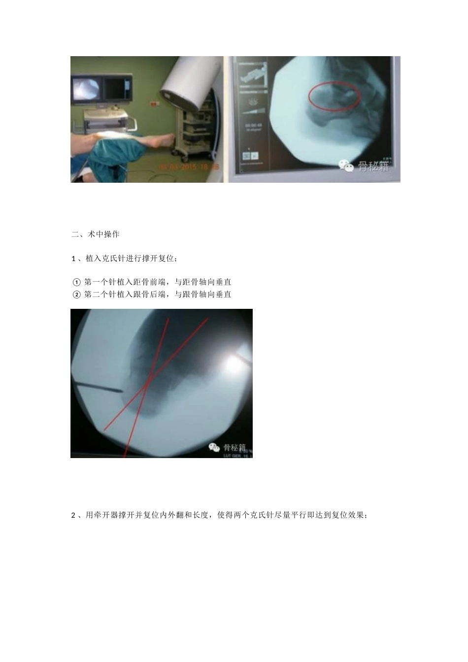 跟骨骨折 你还在切开吗_第7页