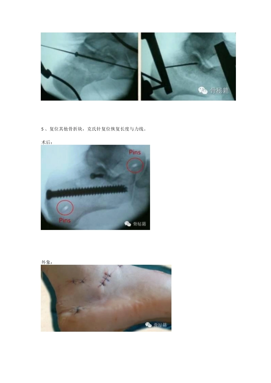 跟骨骨折 你还在切开吗_第9页