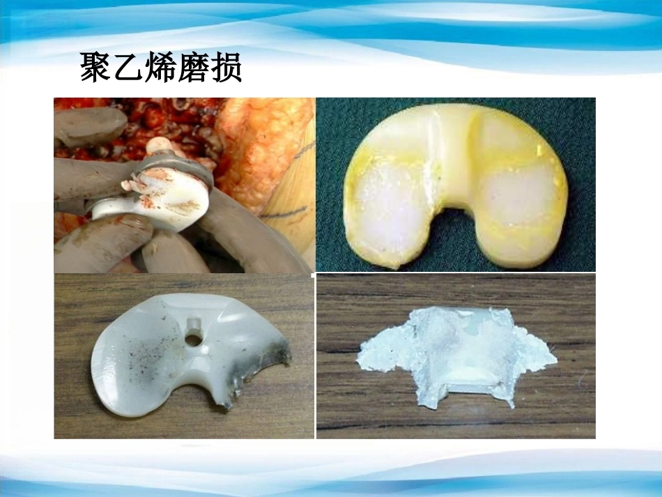 B UKA与TKA 如何选择？_第15页