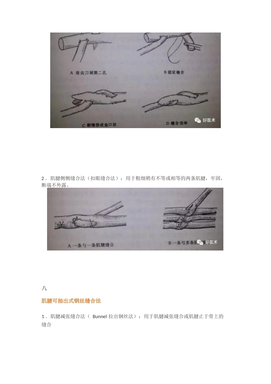 肌腱缝合术方 法汇总_第11页