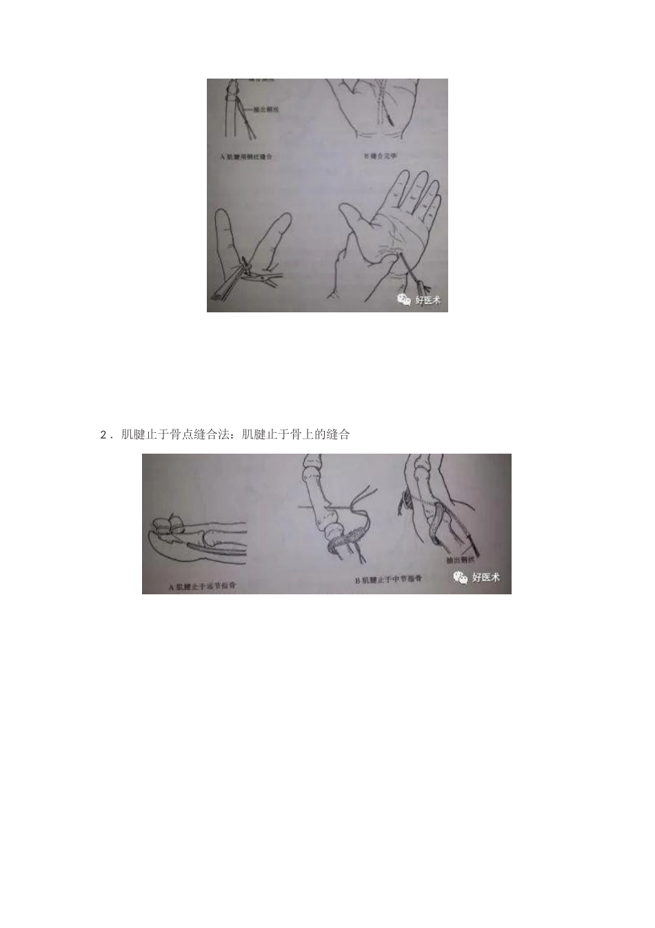肌腱缝合术方 法汇总_第12页