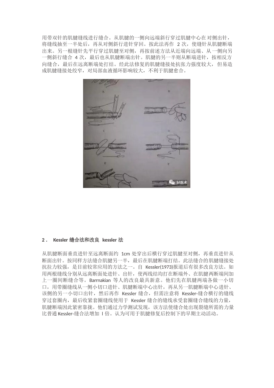 肌腱缝合术方 法汇总_第5页