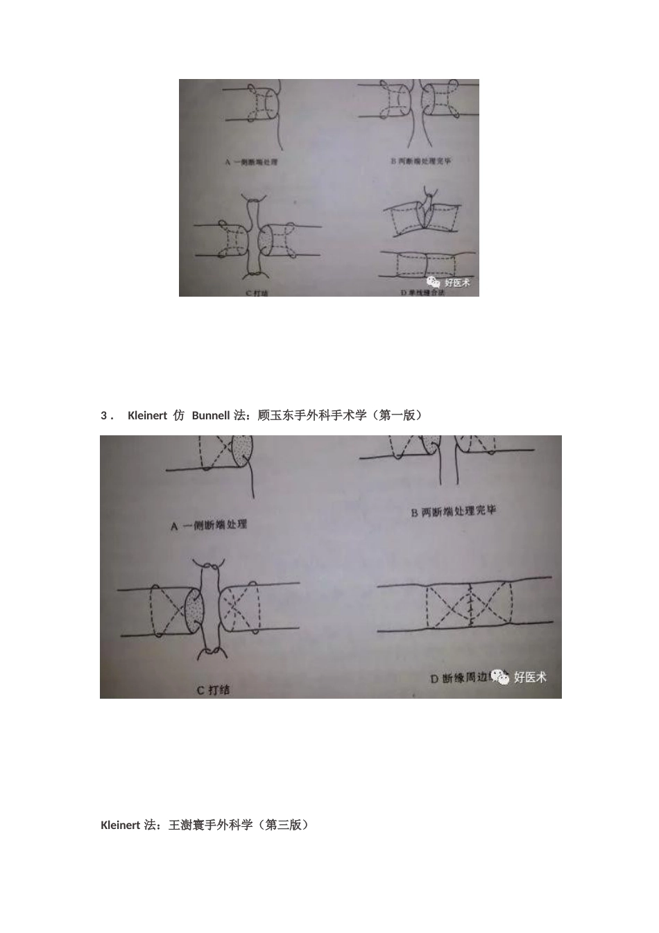 肌腱缝合术方 法汇总_第6页