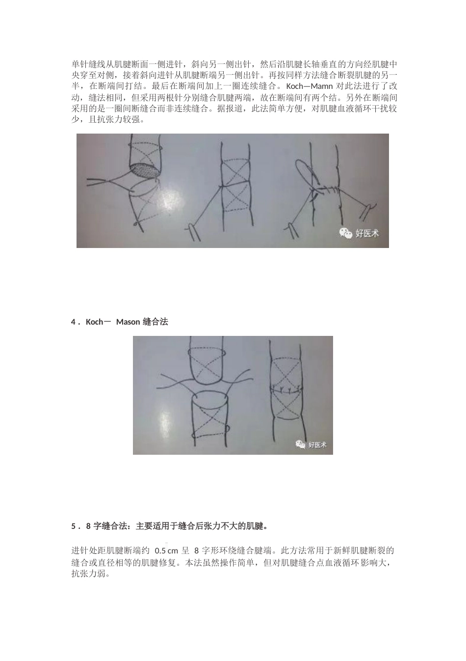 肌腱缝合术方 法汇总_第7页
