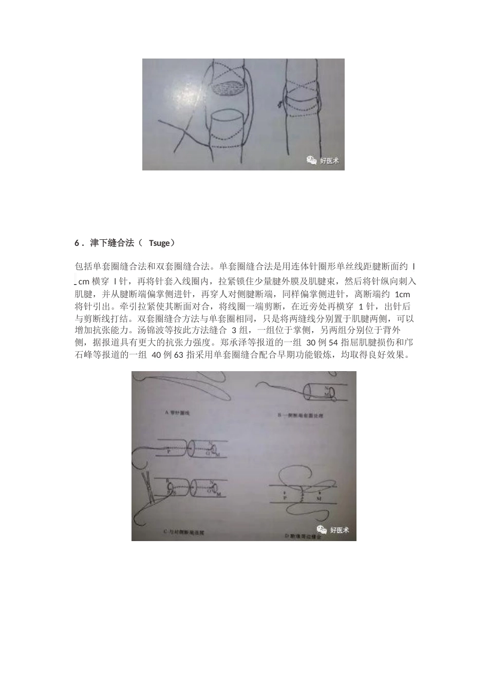 肌腱缝合术方 法汇总_第8页