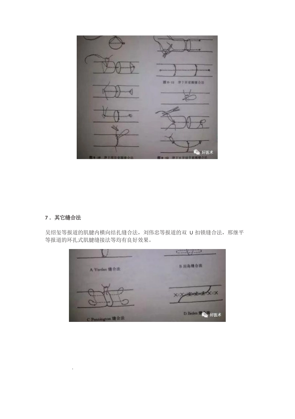肌腱缝合术方 法汇总_第9页