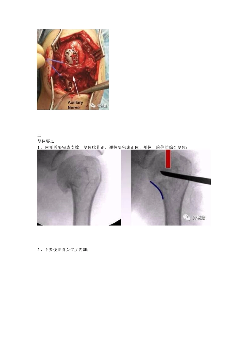 肱骨近端骨折的显露和 复位技术_第5页